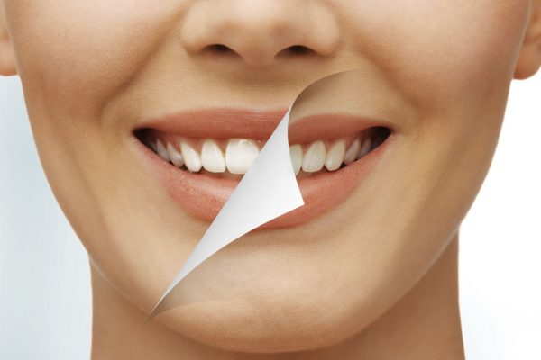BLANQUEAMIENTOS DENTALES: todo lo que necesitas saber si quieres unos dientes más blancos.